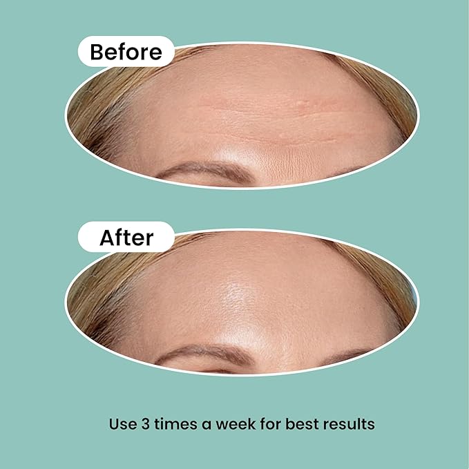 Advanced Wrinkle Patches 20ct Smile Line, Frown Line Wrinkle Patches for Facial Korean Skin Care Face Wrinkle Tape Invisible Overnight with Retinol & Collagen (Large (Forehead))