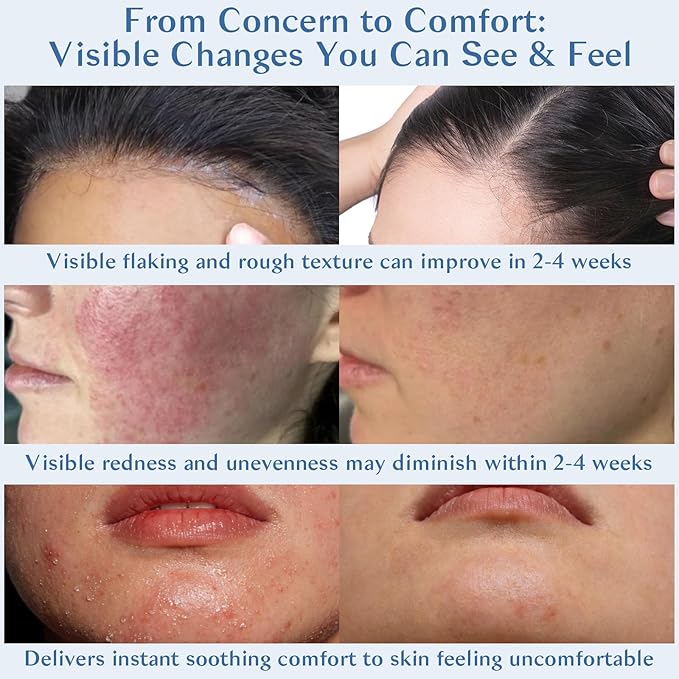 Seborrheic Dermatitis Cream Face & Scalp Soothing – Nourishing Moisturizer with Azelaic Acid, Salicylic Acid, Niacinamide & Urea – Non-Greasy Soothing Care for Dry, Flaky, Irritated Skin