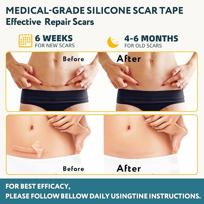 Silicone Scar Tape - 60" x 1.6" Roll - 1.5M, Scar Treatment for Improves Surgical, Keloid, Hypertrophic Scars - Medical Grade Reusable Silicone Scar Sheets