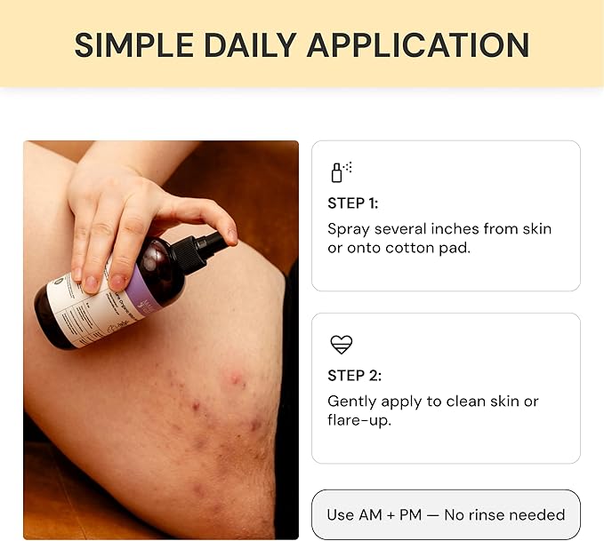 MyMagicHealer Organic Witch Hazel Spray | Calming Flare Care | Gentle Relief for Inflamed, Irritated, Swollen Skin | Ideal for Cystic Acne, Boils, Hidradenitis, Cysts, Ingrowns, and Fissures (8 oz)