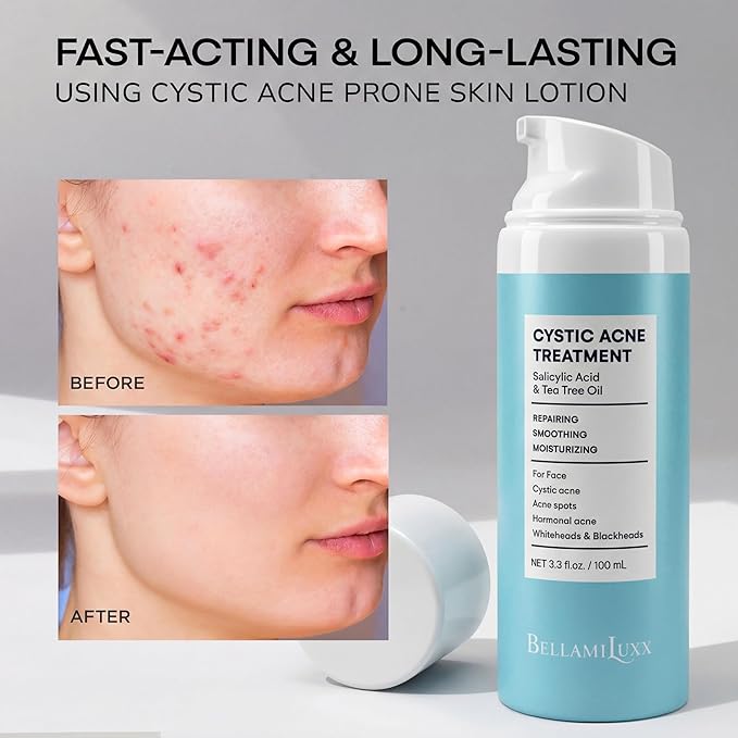 Cystic Acne Treatment for Face: Hormonal Acne Treatment Cream for Teens & Adults - Salicylic Acid & Tea Tree Oil Pimple Spot Remover - Anti-Acne Moisturizer Reduces Redness, Blemishes