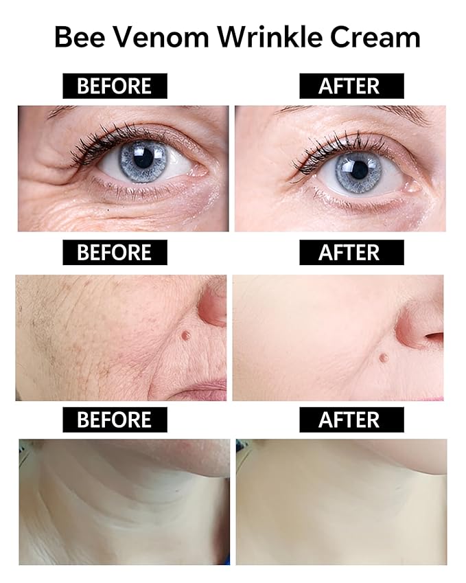 BotoxCream – BotoxBee Venom Wrinkle Removal Cream Anti-Aging, Firming, Lifting, and Moisturizing Skin Cream for All Skin Types – Recovery and Anti-Wrinkle Care (Bee)
