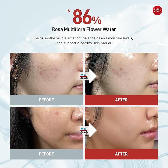 Zeroca 86 Toner - Korean Wild Rose Water for Acne-Prone & Sensitive Skin – Fast Calming & Soothing for Breakout Relief – Calms Redness & Supports Clear Skin,6.76 oz. 200ml