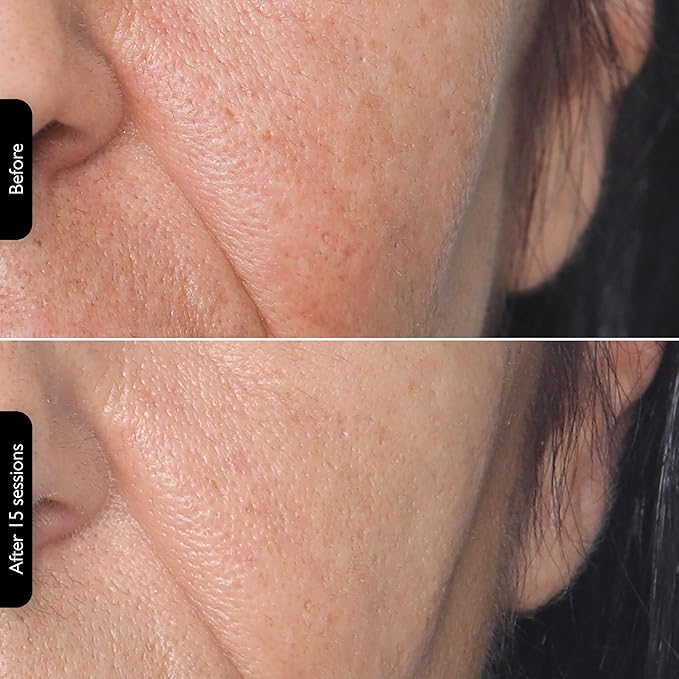 Silk’n Titan Multiplatform At-Home 3-in-1 Radio Frequency Skin Tightening Device for Face and Neck, Combines RF with Low-Level Laser Therapy & Red Light Therapy, with Thermal Sensor, Cordless