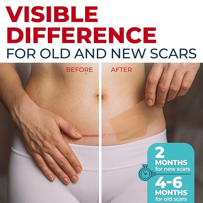 Medical Grade Silicone Scar Tape - 1.6”x120” - Visible Difference on Surgical & Keloid Scars - Reusable Silicone Scar Sheets - Easy to Use Silicone Tape for Scars