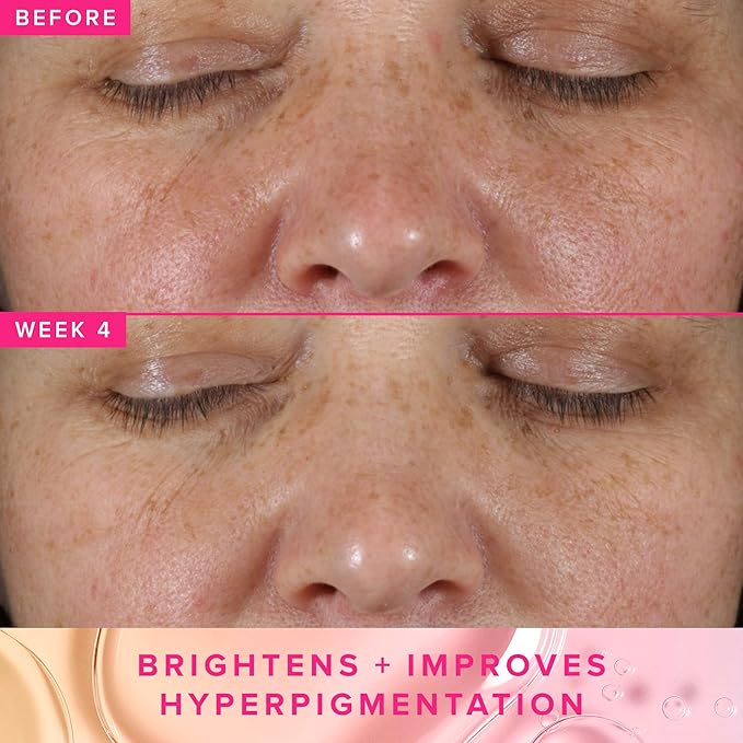 Farmacy 3% TXA Brightening Toner for Face - Dark Spot Corrector with Azelaic Acid, Tranexamic Acid + 5% PHA - Helps Even Texture + Tone, Fade Dark Spots + Exfoliate - Glow-Enhancing Skin Care (50ml)