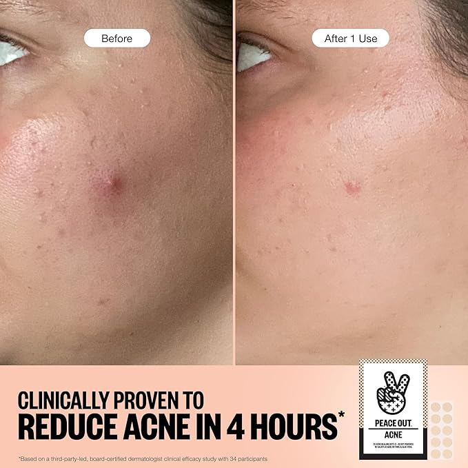 PEACE OUT Acne Healing Dots Hydrocolloid Pimple Patches, Acne Spot Treatment with Salicylic Acid, Retinol, and Aloe Vera for Blemishes and Breakouts, 40 Count