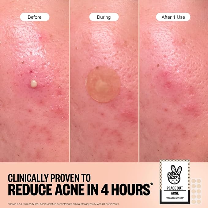PEACE OUT Acne Healing Dots Hydrocolloid Pimple Patches, Acne Spot Treatment with Salicylic Acid, Retinol, and Aloe Vera for Blemishes and Breakouts, 40 Count