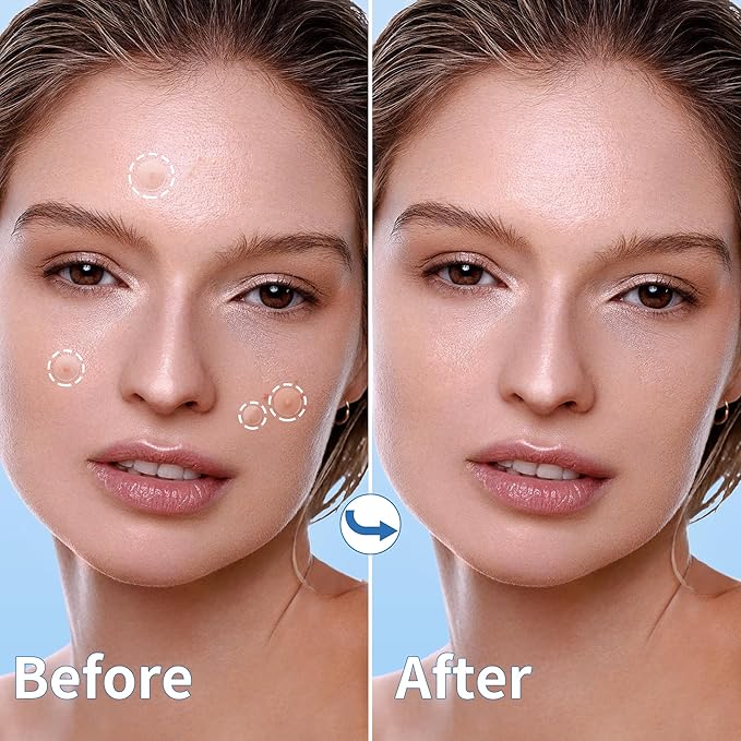Pimple Patches for Face - 3 Size 510 Counts Hydrocolloid Acne Patches for Covering Zits and Blemishes, Spot Stickers with Salicylic Acid, Tea Tree Oil & Calendula Oil(8mm,10mm,12mm)