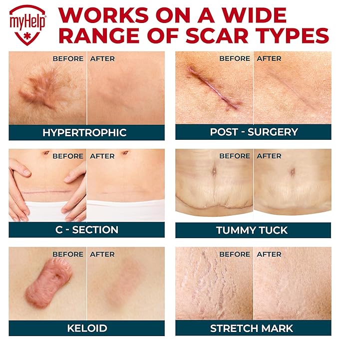 Medical Grade Silicone Scar Tape - Transparent (1.6”x60”) - Visible Difference on Surgical & Keloid Scars - Reusable Silicone Scar Sheets - Easy to Use Silicone Tape for Scars