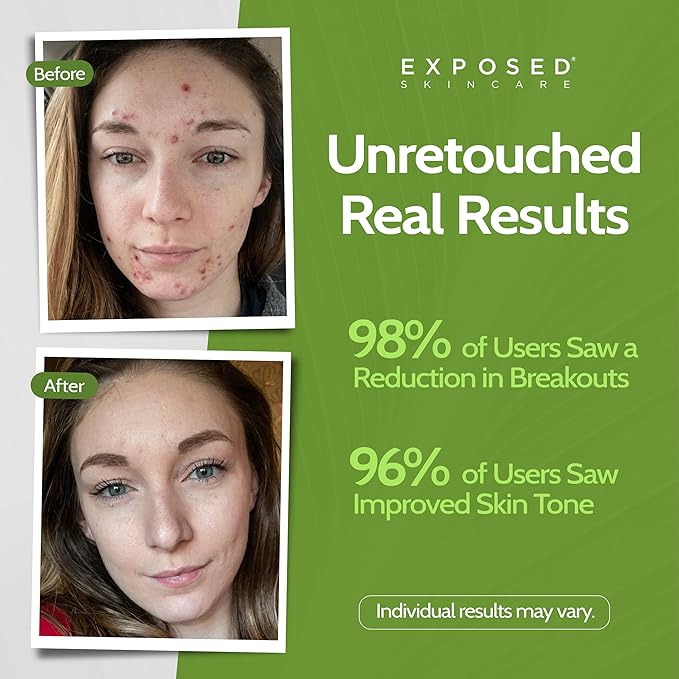 Exposed Skin Care, Clearing Tonic Facial Toner with 1% Salicylic Acid and Witch Hazel – Daily Toner for Teen and Adult Acne, Blackheads and Oily Skin – Natural, Non-Toxic and Cruelty Free