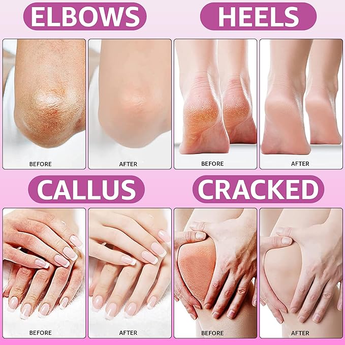 10% Urea Cream with Aloe Vera, Jojoba Oil and Salicylic Acid - 150ml Hydrating Moisturizer for Dry, Chapped Hands, Feet, Face & Body - Repairs, Soothes & Nourishes Rough, Dry Skin - 4 Oz