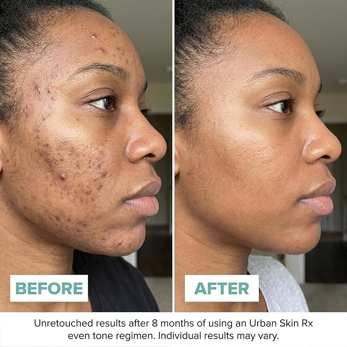 Urban Skin Rx® Vitamin C + E Glowing Moisturizer, Lightweight Antioxidant-Rich Daily Moisturizer for Combination Skin, Multi-Vitamin Complex Smooths Texture & Reduces Appearance of Wrinkles, 1.7 Oz