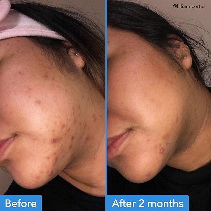 Good Molecules Discoloration Correcting Serum Pack 2 – 30 ml Each | Tranexamic Acid & Niacinamide Serum to Target Dark Spots and Hyperpigmentation, Skin Care for Face