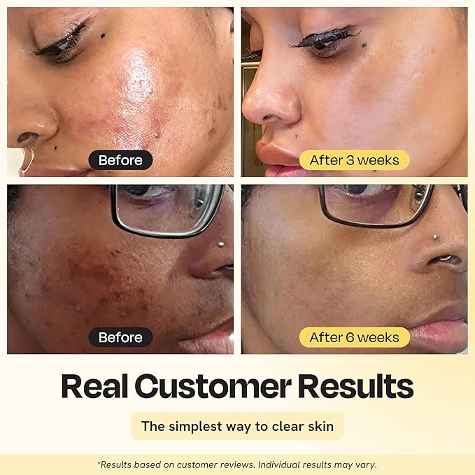 Gleamin Vitamin C Clay Mask for Dark Spots - Brightening Clay Face Mask with Turmeric, Deep Cleansing & Pore Refining Treatment, Helps Improve Uneven Tone & Post-Blemish Texture, 2.5 oz Up to 20 Uses
