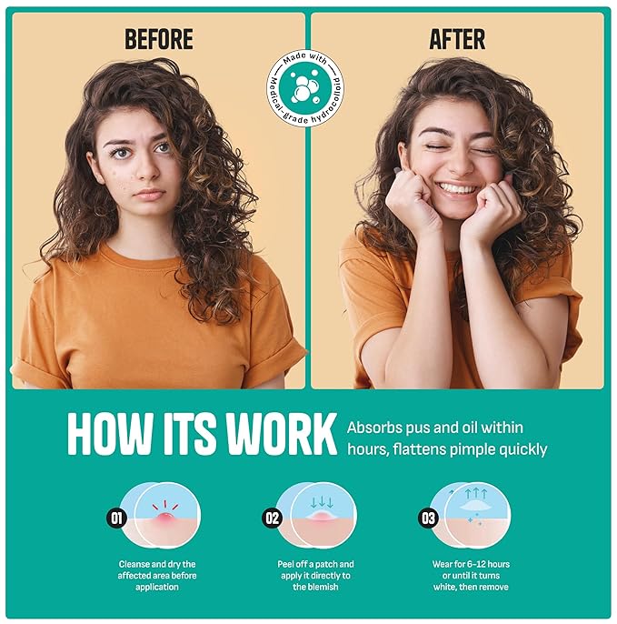 Pimple Patches for Face – Day & Night Acne Patches for Fast Healing, Skin Clarity – Invisible Hydrocolloid Patches, Waterproof Spot Treatment – All Skin Types Zit Patches of 60/120/180