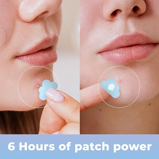 Pimple Patches for Face Cute (Hearts, Clouds Pink and Blue), Zit Patches Star Sticker 240 pack