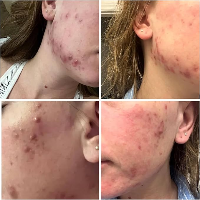 BalanC Toner | Pregnancy Safe Blemish Treatment | Aloe Vera & Witch Hazel | Alcohol Free