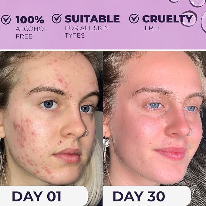 NxN Acne Facial Toner with Salicylic Acid, Witch Hazel, Probiotics & Natural Multi-Fruit Extracts Alcohol Free Treatment for All Skin Types