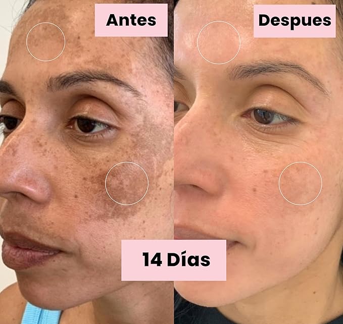 Generic Tonico Despigmentante LB *Elimina pecas, barros, paños, melasma*