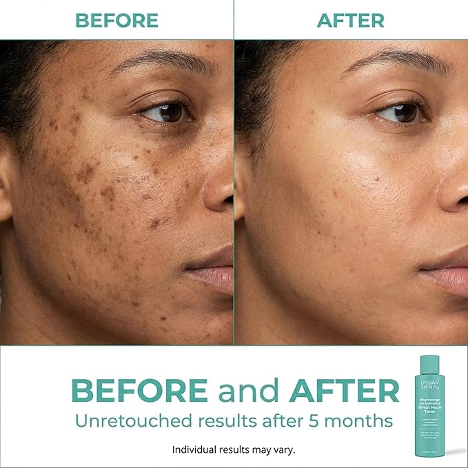 Urban Skin Rx® Witch Hazel Brightening & pH Balancing Toner, Exfoliated & Clarifies Clogged Pores, Improves The Appearance of Uneven Skin Tone, Reduces Redness & Brightens Dull Complexions, 4.5 Fl Oz