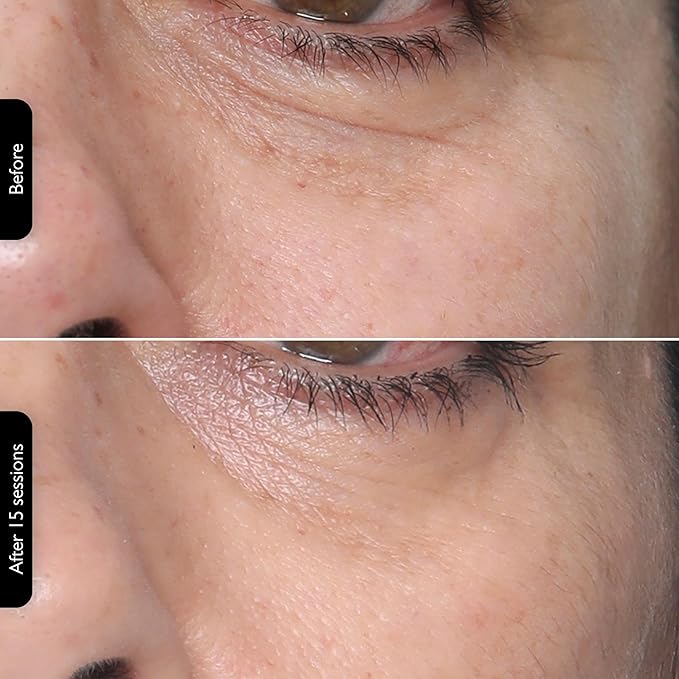 Silk’n Titan Multiplatform At-Home 3-in-1 Radio Frequency Skin Tightening Device for Face and Neck, Combines RF with Low-Level Laser Therapy & Red Light Therapy, with Thermal Sensor, Cordless