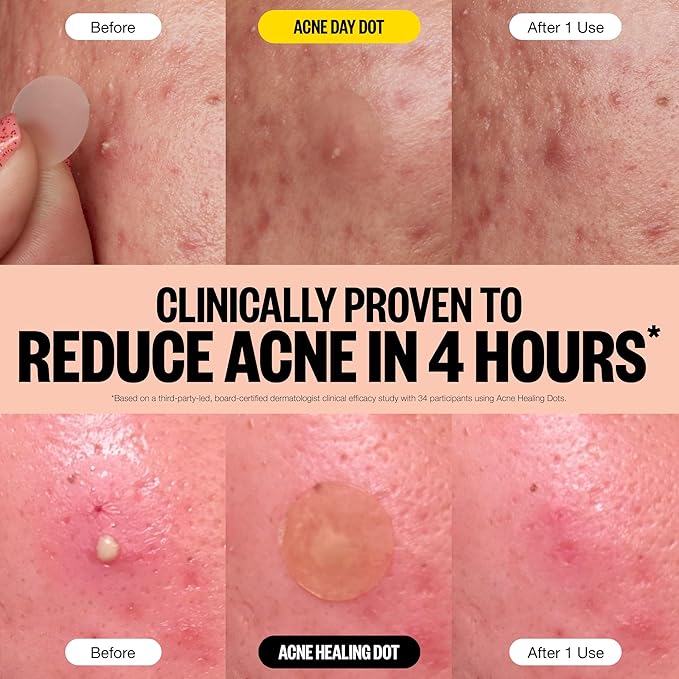PEACE OUT Acne Day & Night Duo, Invisible Acne Patches for Day + Healing Overnight Acne Treatment, Clear Blemishes Fast with 2% Salicylic Acid, Retinol & Aloe Vera, 20 Dots