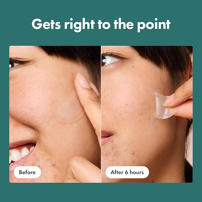 Mighty Patch Micropoint Large Hydrocolloid Pimple Patches for Face Blemishes from Hero Cosmetics, Acne Stickers for Early Stage Zits & Hidden Pimples, 1,385 Proprietary Micropoints, 6 Count