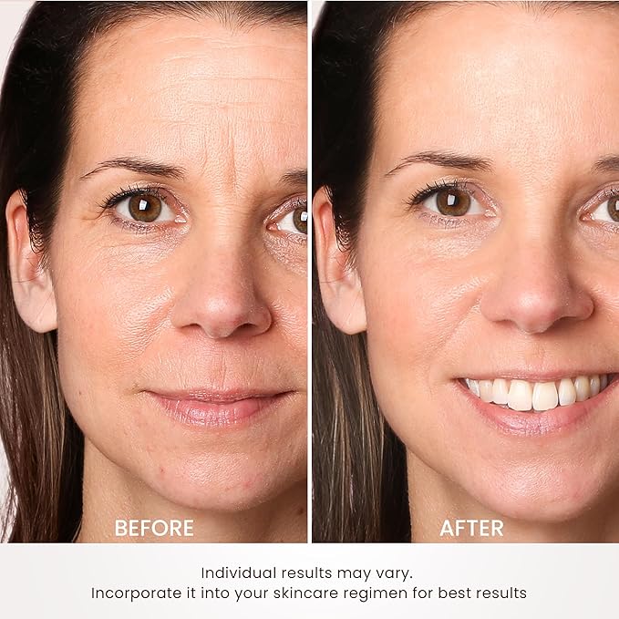 Skin Tightening Device | 6 in 1 Radio Frequency Skin Tightening Device | Professional Face Tightening | Lifting | Wrinkle Reducing | Depuff | Absorb | at Home RF Anti Aging Face Beauty Device