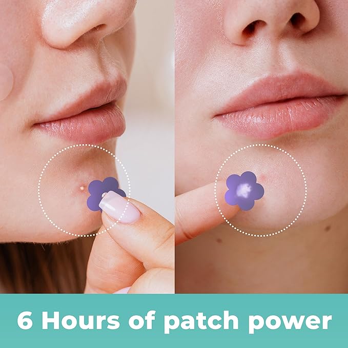 Acne Patches Flower Beads Design (80 pack, 5 colors) Zit Patches Star Sticker