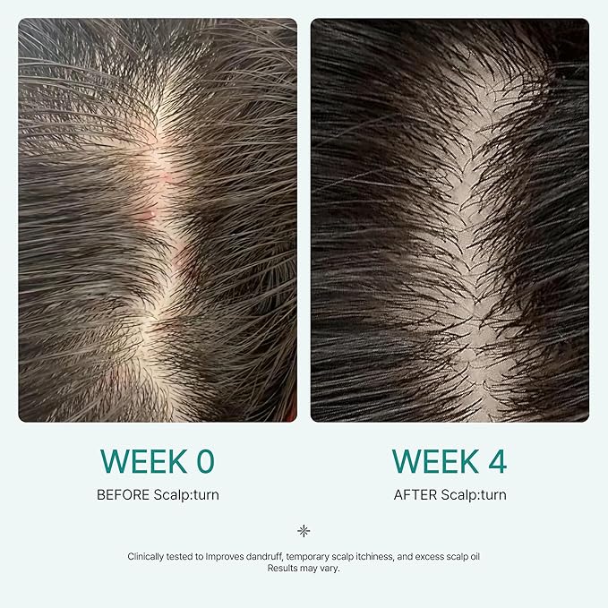 lilyeve SCALPTURN Cica PDRN Scalp Serum with Built-in Brush, PDRN to Strengthen Hair Roots, Itchy Scalp Relief, Dry Scalp Hydration - Korean Hair Care, 1.01 fl. oz.